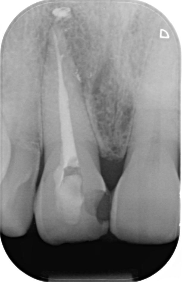 Caso clinico apicectomia: radiografia della situazione iniziale
