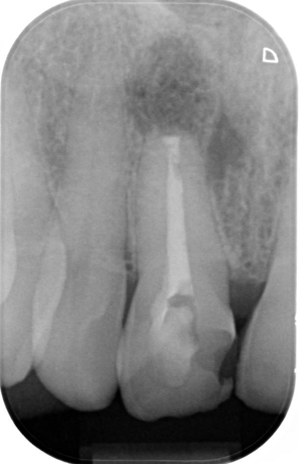 Caso clinico apicectomia: radiografia il giorno dell'intervento