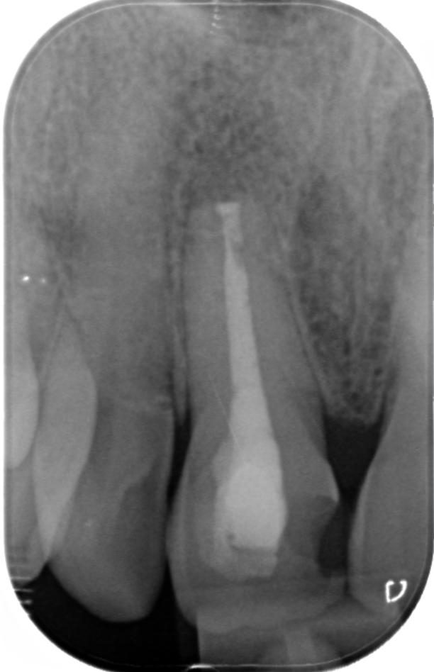 Caso clinico apicectomia: radiografia a tre mesi dall'intervento