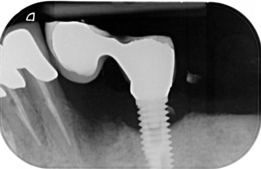Caso clinico perimplantite: radiografia dopo l'estrazione e la disinfezione dell'impianto