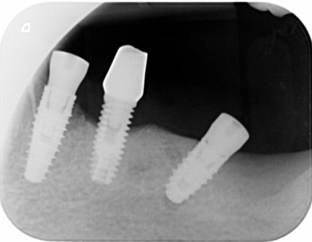 Caso clinico perimplantite: radiografia dopo il posizionamento degli impianti