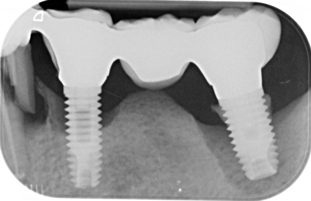 Caso clinico perimplantite: radiografia della situazione iniziale