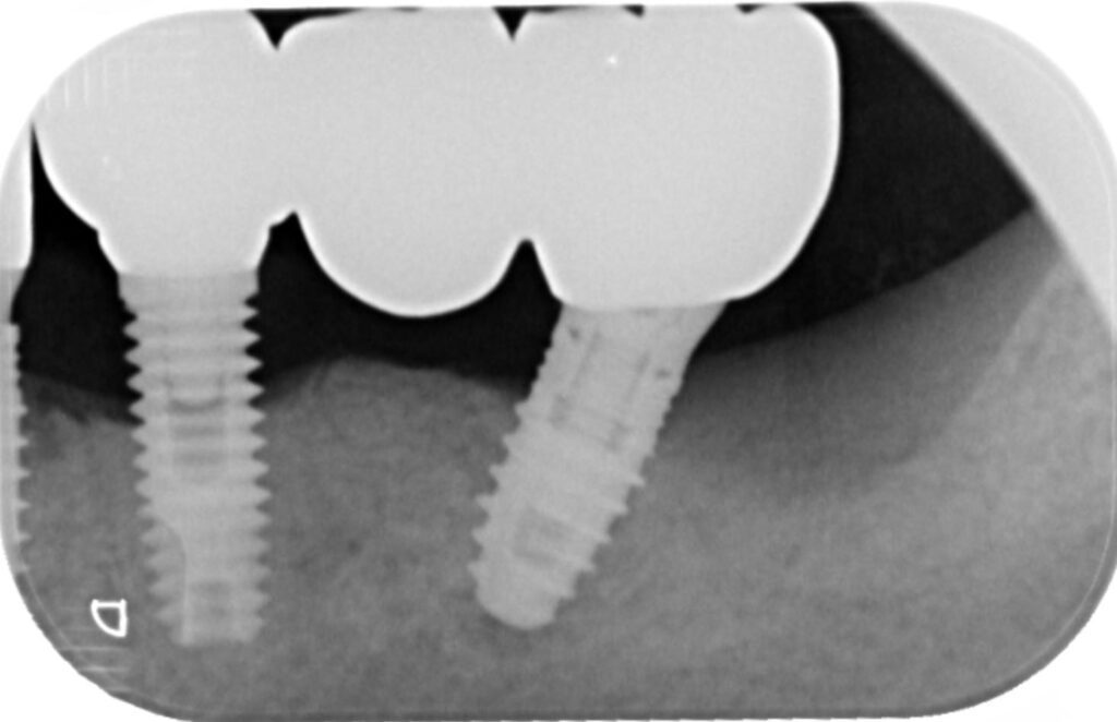 Caso clinico perimplantite: radiografia alla consegna del lavoro definitivo